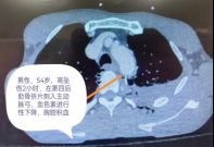跨越山海的合作：达州市中心医院远程MDT会诊 助力患者转危为